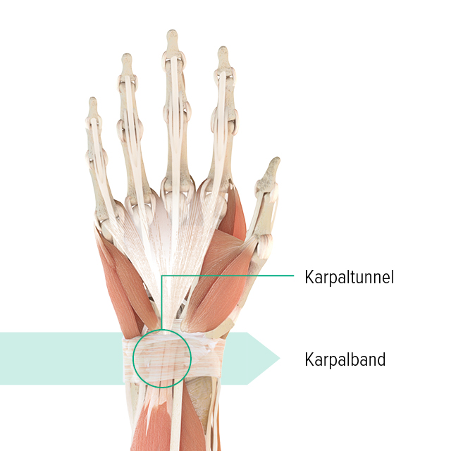 Anatomie-Grafik der linken Hand mit Markierung des Karpaltunnels und des Karpalbandes