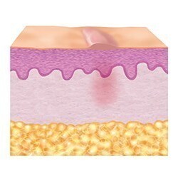 3. Repair phase (epithelisation) 3. Repair phase (epithelisation)