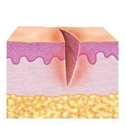 1. Cleaning phase (inflammation phase) 1. Cleaning phase (inflammation phase)