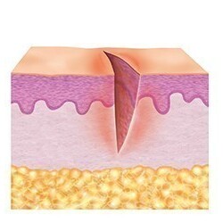 1. Fase da limpeza (fase de exsudação) 1. Fase da limpeza (fase de exsudação)