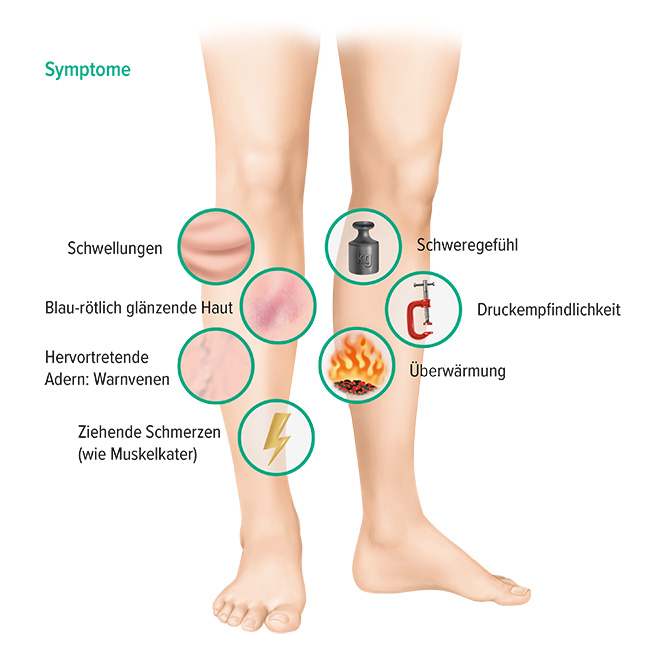 Symptome tiefe Venenthrombose Symptome tiefe Venenthrombose