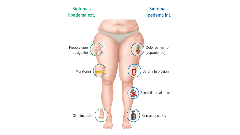 Gráfico de síntomas del lipedema Gráfico de síntomas del lipedema