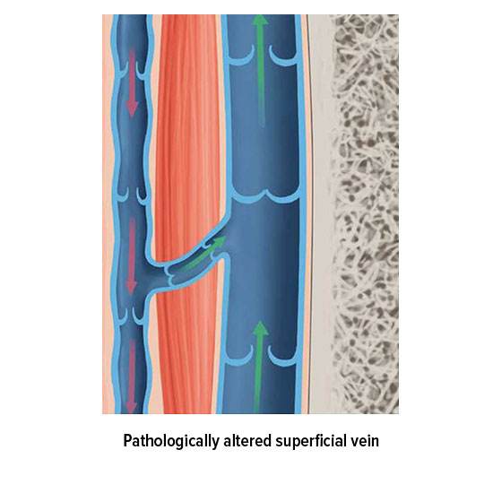 Pathologically altered superficial vein Pathologically altered superficial vein