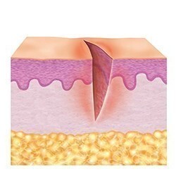 1. Reinigingsfase van de huid (ontstekingsfase) 1. Reinigingsfase van de huid (ontstekingsfase)