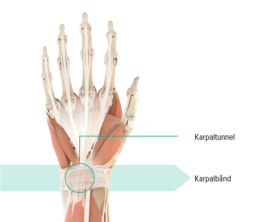 Anatomisk illustration af venstre hånd med markering af karpaltunnelen og karpalleddet Anatomisk illustration af venstre hånd med markering af karpaltunnelen og karpalleddet