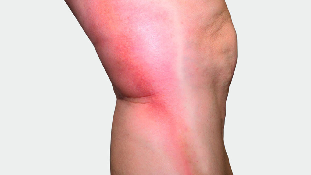 Beininnenseite, an der man eine rote Verfärbung sieht Beininnenseite, an der man eine rote Verfärbung sieht