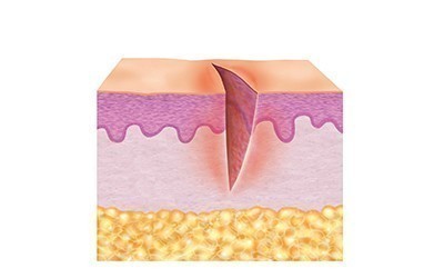 1. Fase de limpieza (fase de inflamación) 1. Fase de limpieza (fase de inflamación)