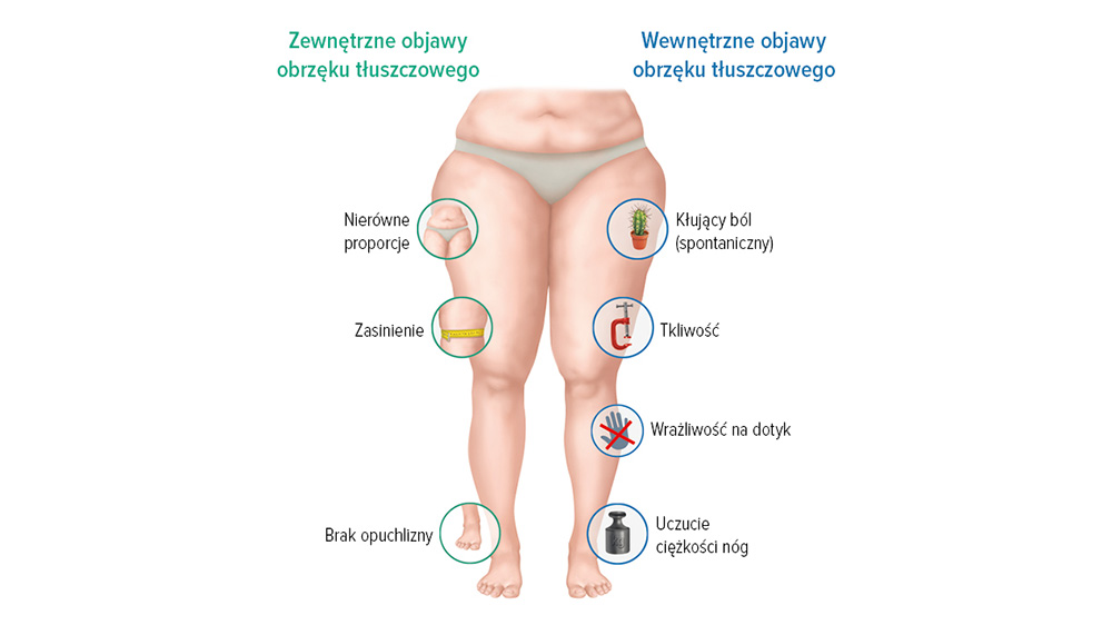Grafika – objawy obrzęku lipidowego Grafika – objawy obrzęku lipidowego